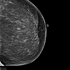 Erken Teşhis Hayat Kurtarır: Mamografi ve Meme Kanseri