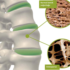 Osteoporoz Nedir?