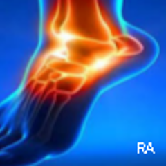 Romatoid Artrit (RA) ve Fibromiyalji 